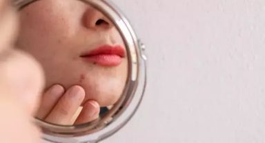 Prof. Dr. İbrahim Saraçoğlu'ndan sivilcelerin kökünü kurutan etkili 3 kür! 'HAFTADA 4 KEZ UYGULAMAK YETİYOR'